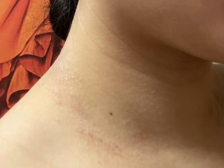 发红发痒，耳朵肿成“招风耳”！医院一查懵了，“元凶”竟是这种常见的小东西