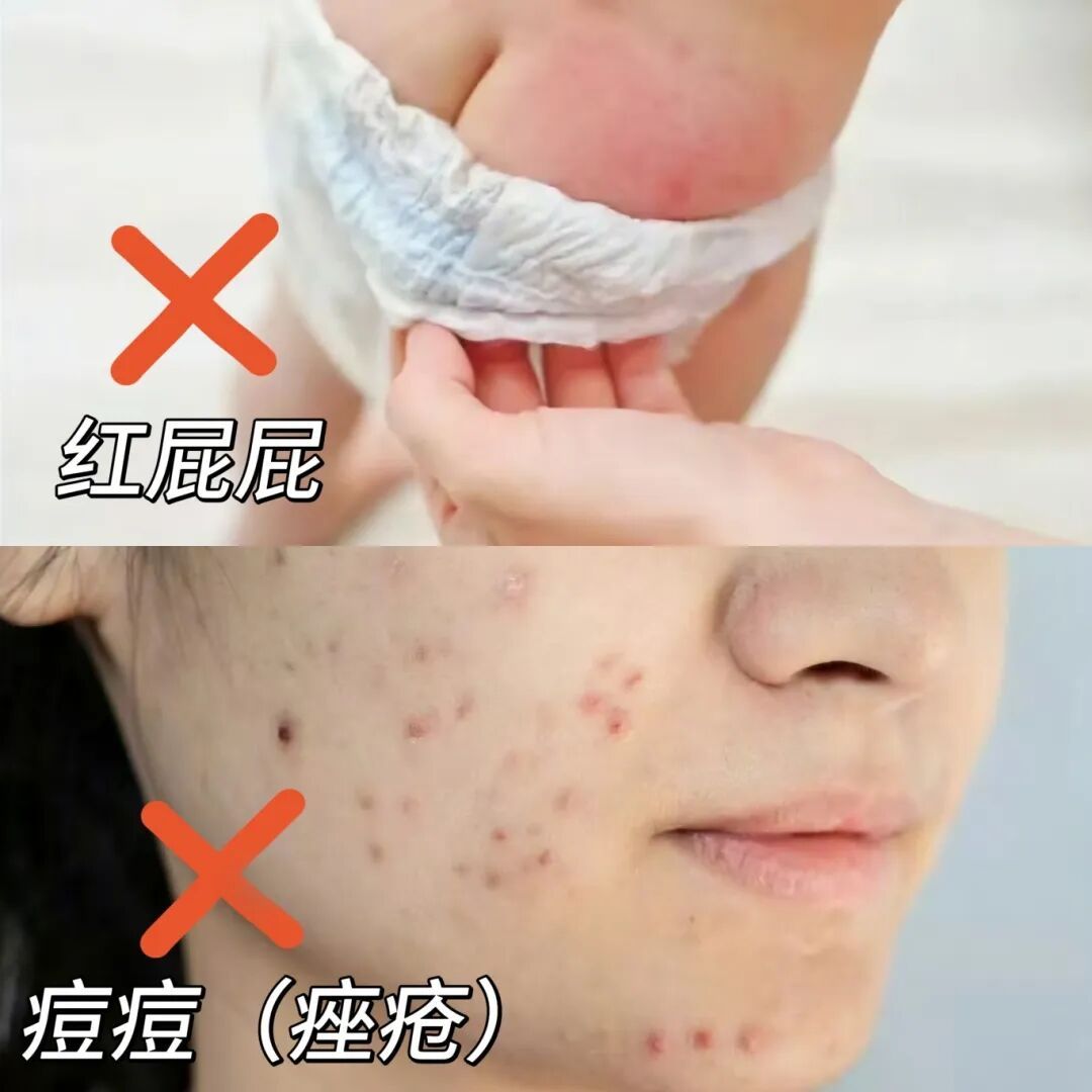 红霉素软膏真能治一切？这5种情况涂了等于找罪受！