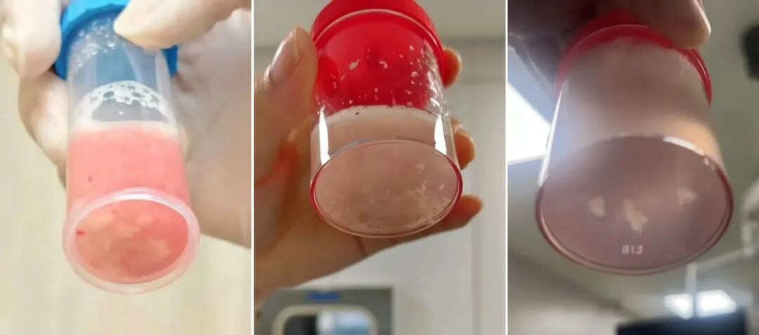 发热仅1天,肺全白了!这种病极度危险,千万别当普通感冒! 发热仅1天,肺全白了!这种病极度危险,千万别当普通感冒!