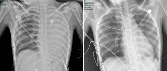 发热仅1天,肺全白了!这种病极度危险,千万别当普通感冒! 发热仅1天,肺全白了!这种病极度危险,千万别当普通感冒!