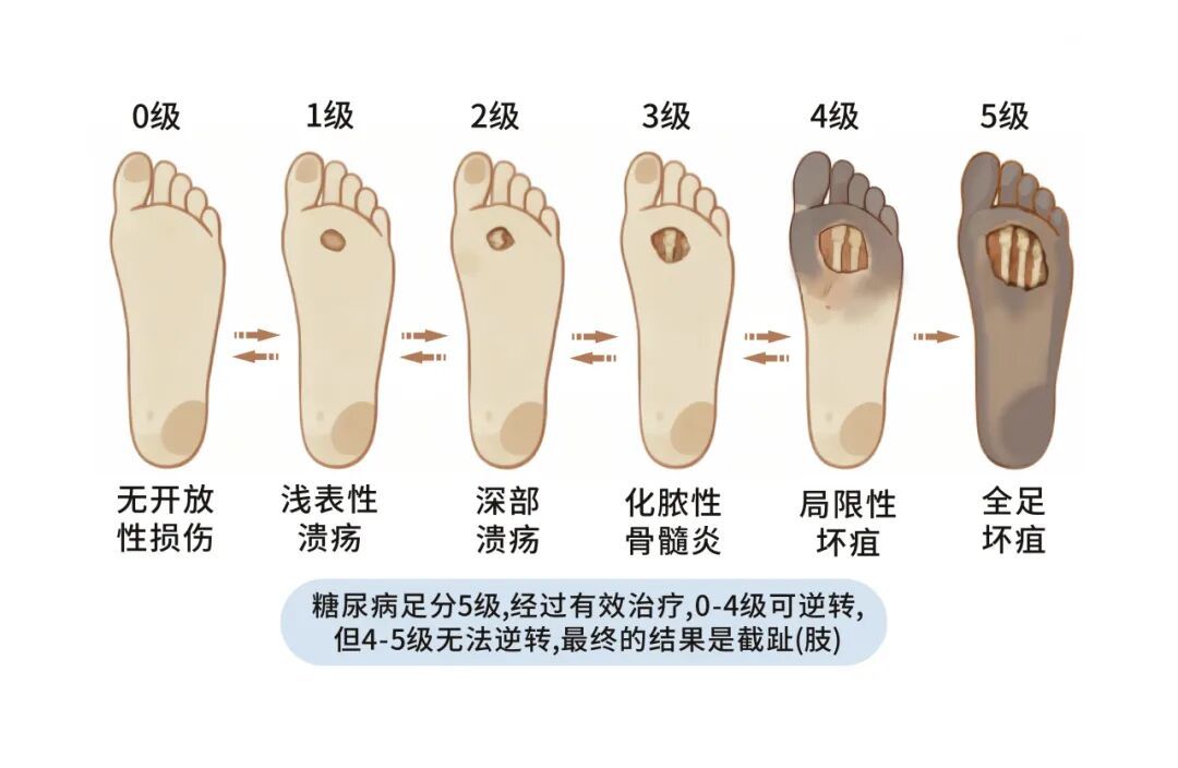 总觉得饿、视力变差……超一半人不知道自己得了糖尿病！