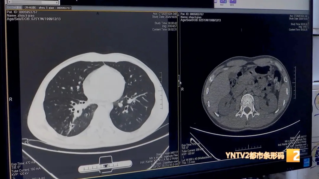 25岁小伙咳嗽带血10年！原来…… 气管里竟藏着铁钉！