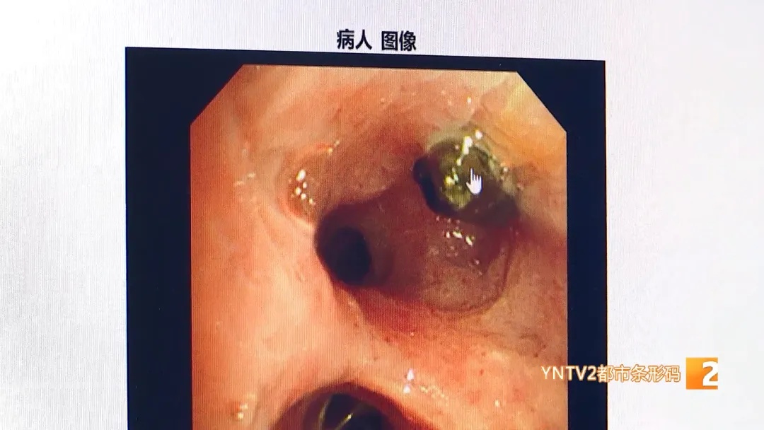 25岁小伙咳嗽带血10年！原来…… 气管里竟藏着铁钉！