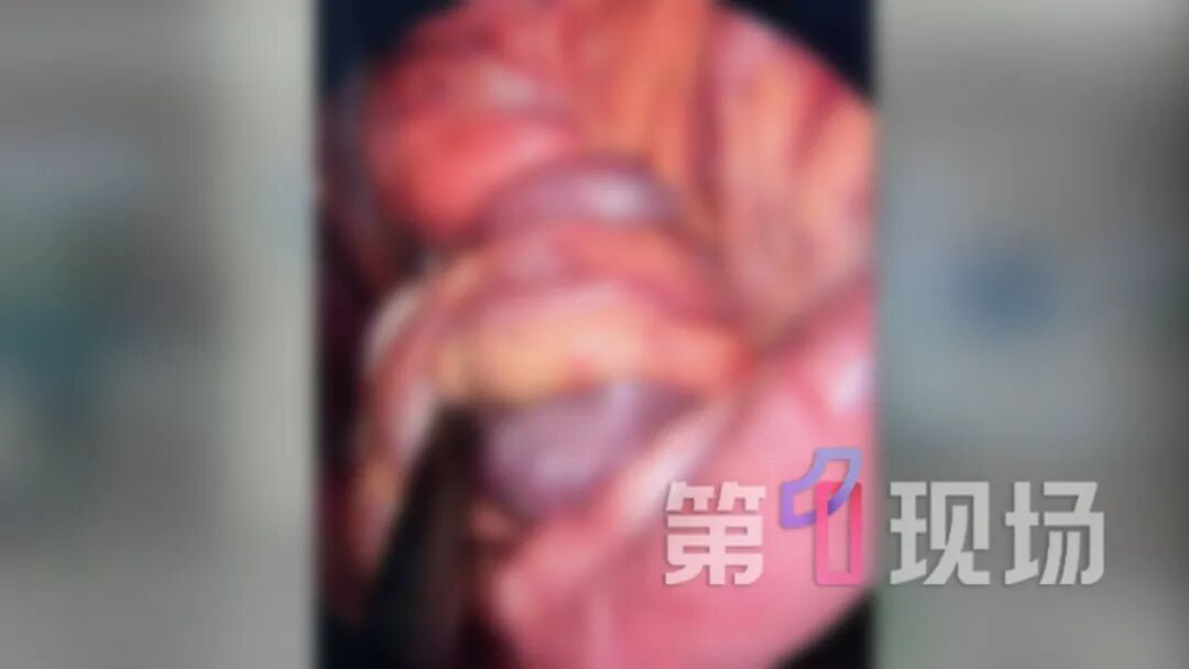或将致命！4岁男童肠子拧成两圈“大麻花”...医生：拉响最高警报
