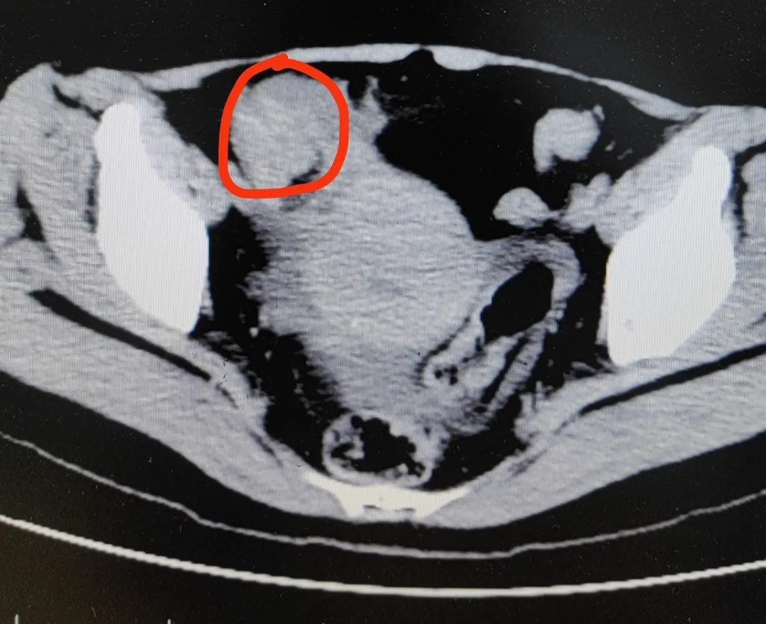 女子连吃3个，痛到进医院！正大量上市