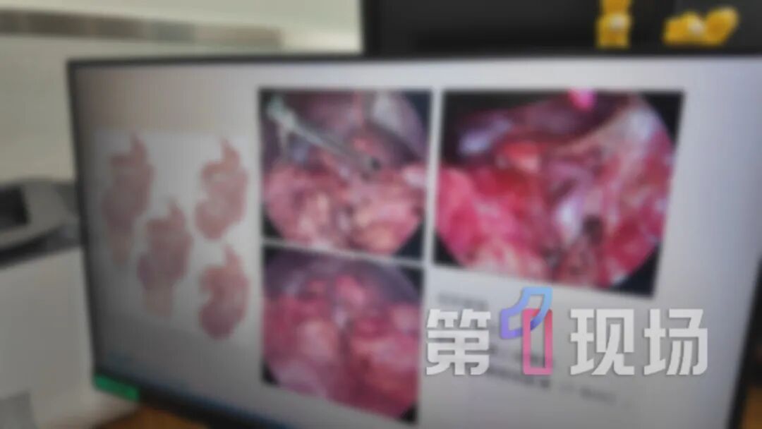 或将致命！4岁男童肠子拧成两圈“大麻花”...医生：拉响最高警报