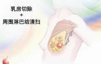 乳腺癌术后,胳膊有条筋,小心是腋网综合征! 乳腺癌术后,胳膊有条筋,小心是腋网综合征!