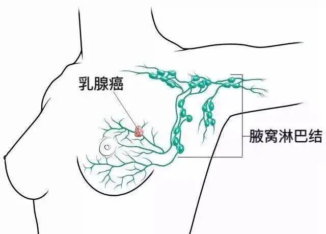 乳腺癌术后,胳膊有条筋,小心是腋网综合征! 乳腺癌术后,胳膊有条筋,小心是腋网综合征!