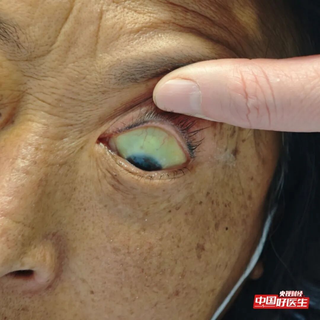 手抖不一定是帕金森！出现这种震颤是肝脏发出的“警报”，速检查→