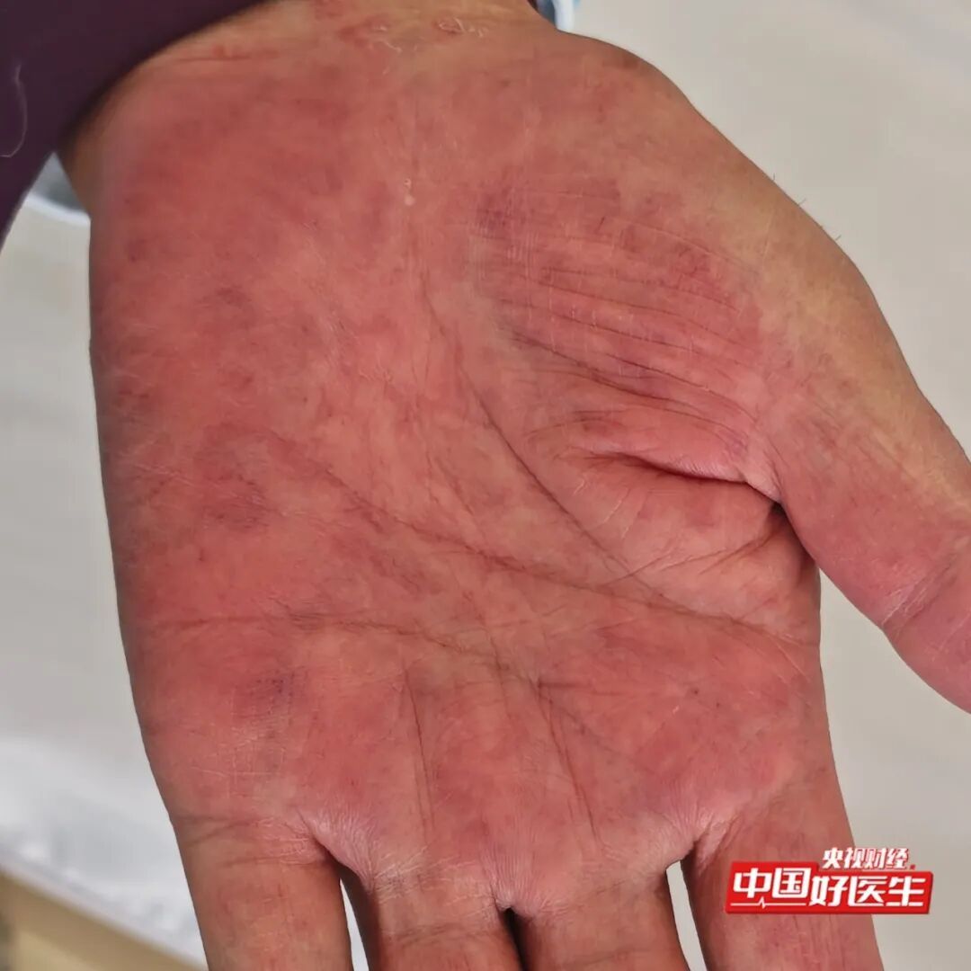 手抖不一定是帕金森！出现这种震颤是肝脏发出的“警报”，速检查→