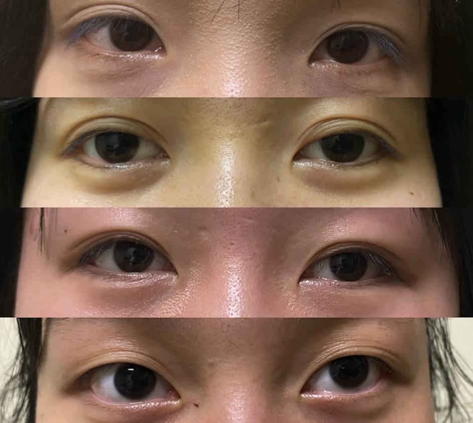 贴了双眼皮贴后别再“硬扯”了！这几招教你安全变美！