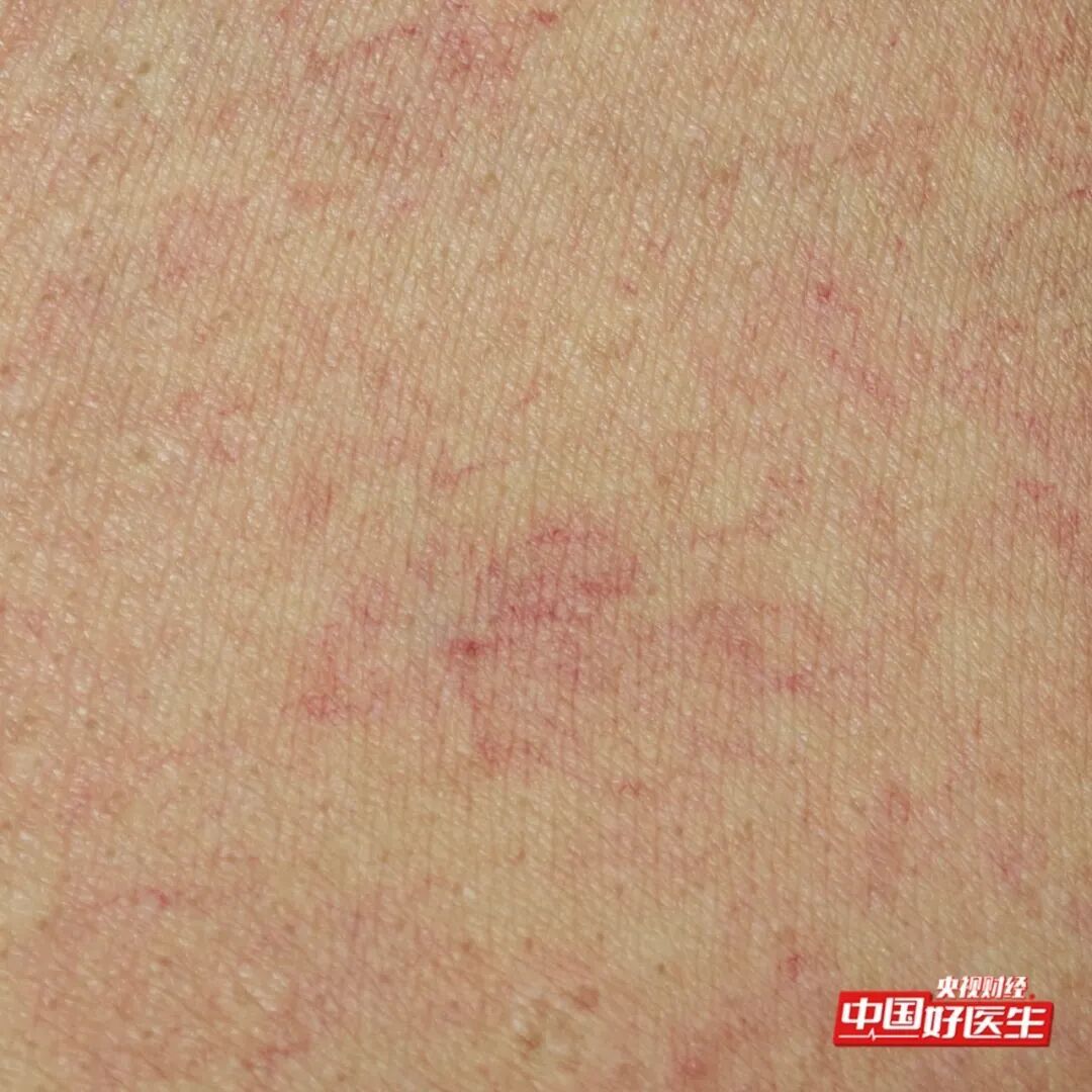 手抖不一定是帕金森！出现这种震颤是肝脏发出的“警报”，速检查→