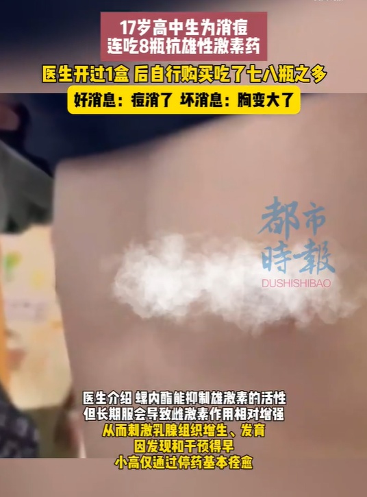 17岁高中生为消痘，连吃8瓶抗雄性激素药！好消息：痘消了，坏消息：胸变大了