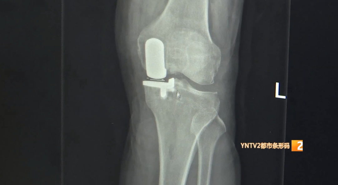 跑步和久坐到底哪个更伤膝盖？骨科医生揭秘真相！