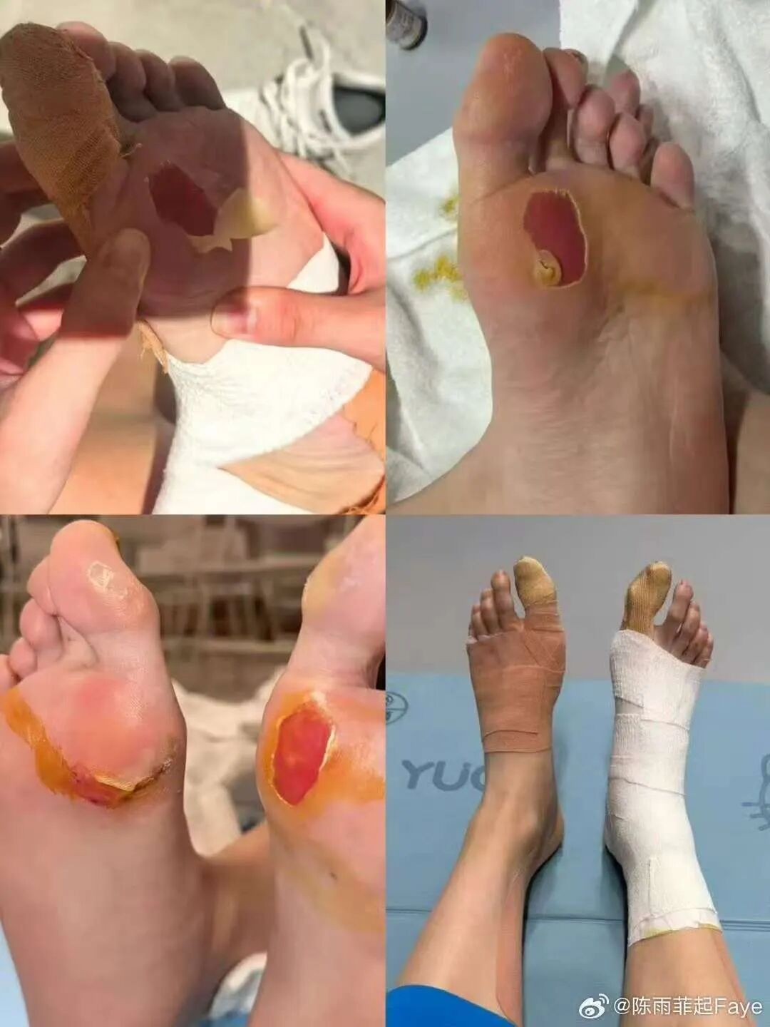 杭州姑娘陈雨菲夺得羽毛球女单银牌,赛后晒脚伤照,“我最后一届全运会,问心无愧” 杭州姑娘陈雨菲夺得羽毛球女单银牌,赛后晒脚伤照,“我最后一届全运会,问心无愧”