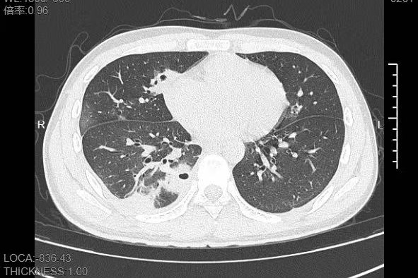 触目惊心！20岁男生脸上挤痘痘住进ICU，挤了一颗痘痘肺部出现10多个洞！