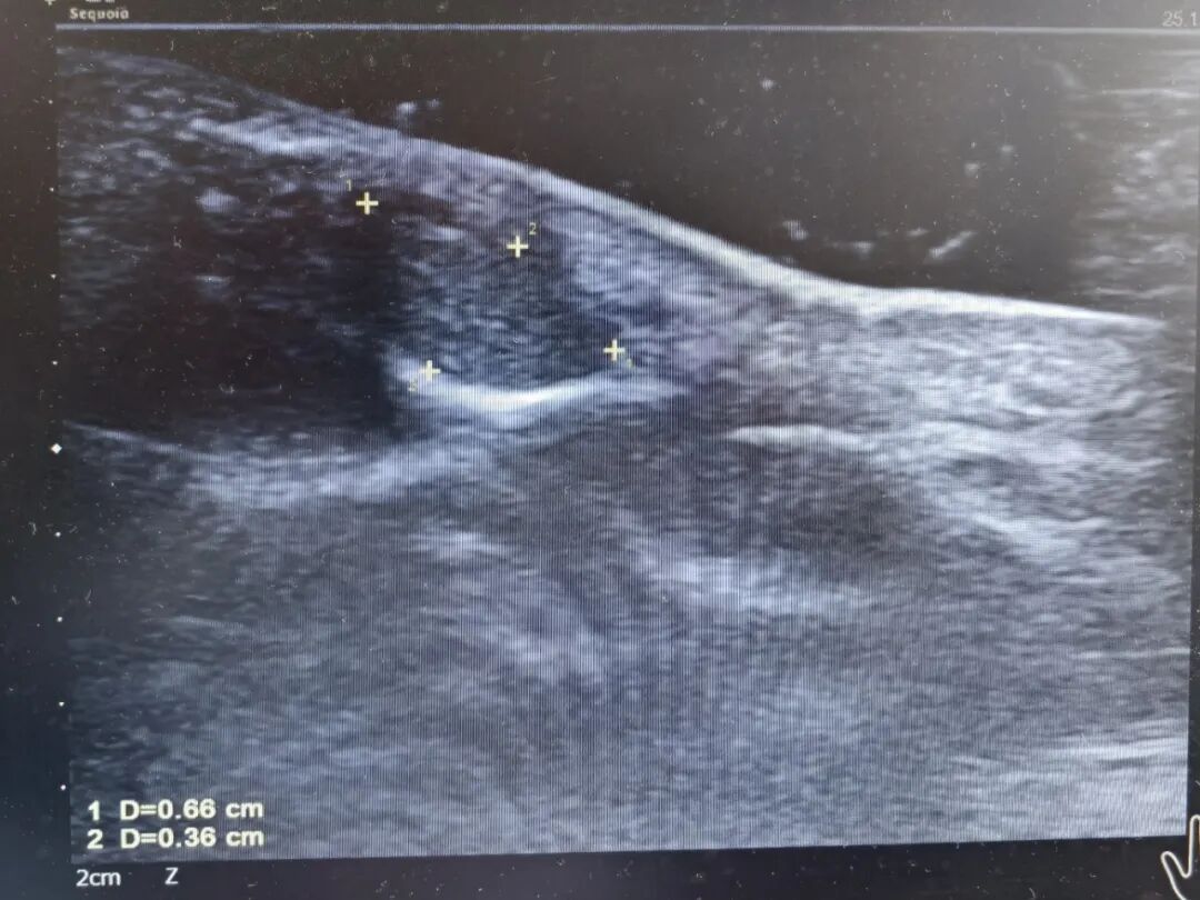 男子百思不得其解，像是被”容嬷嬷”一直跟着，时不时就往指甲里扎两针！