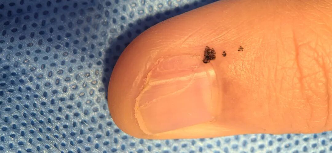 男子百思不得其解，像是被”容嬷嬷”一直跟着，时不时就往指甲里扎两针！