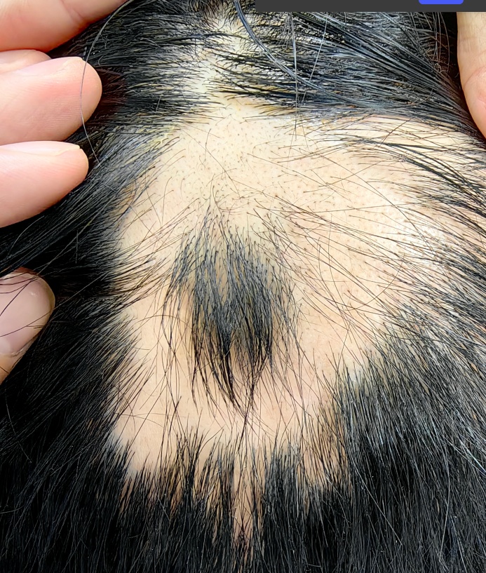 一觉醒来,头顶秃了一大片!“90后”小伙慌了,元凶很多人都有…… 一觉醒来,头顶秃了一大片!“90后”小伙慌了,元凶很多人都有……