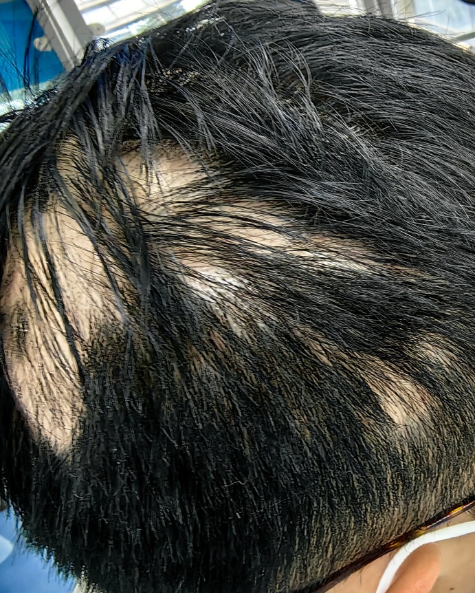 一觉醒来,头顶秃了一大片!“90后”小伙慌了,元凶很多人都有…… 一觉醒来,头顶秃了一大片!“90后”小伙慌了,元凶很多人都有……