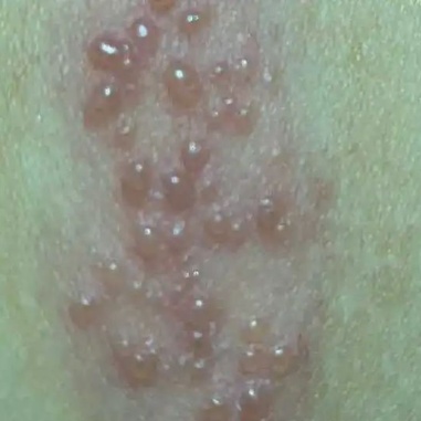 女子拆快递后确诊感染，可达“10级疼痛”！