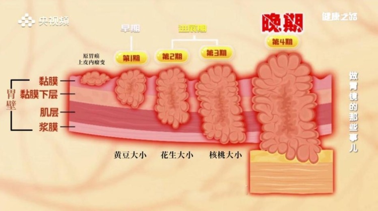 两年4次胃镜漏诊胃癌！饭后出现这4个症状要当心