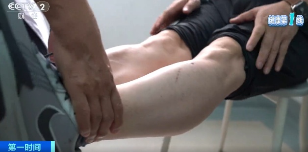 超1亿人患病！以为关节炎只是老年病？这些因素正让它悄悄盯上年轻人