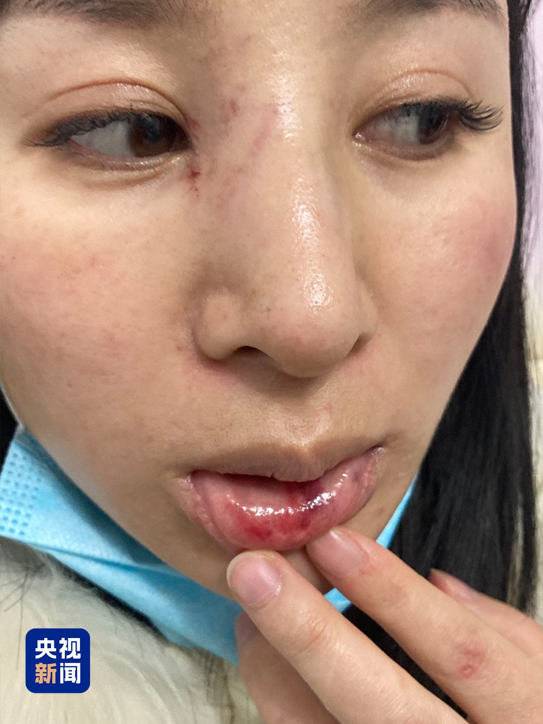 结婚两年遭遇多次家暴，4处重伤！受害者是否走出阴霾？