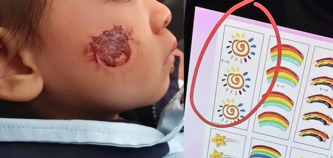 从网上买贴纸贴脸上，3岁女孩脸部糜烂严重！家长：懊悔不已