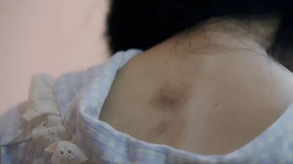 结婚两年遭遇多次家暴，4处重伤！受害者是否走出阴霾？