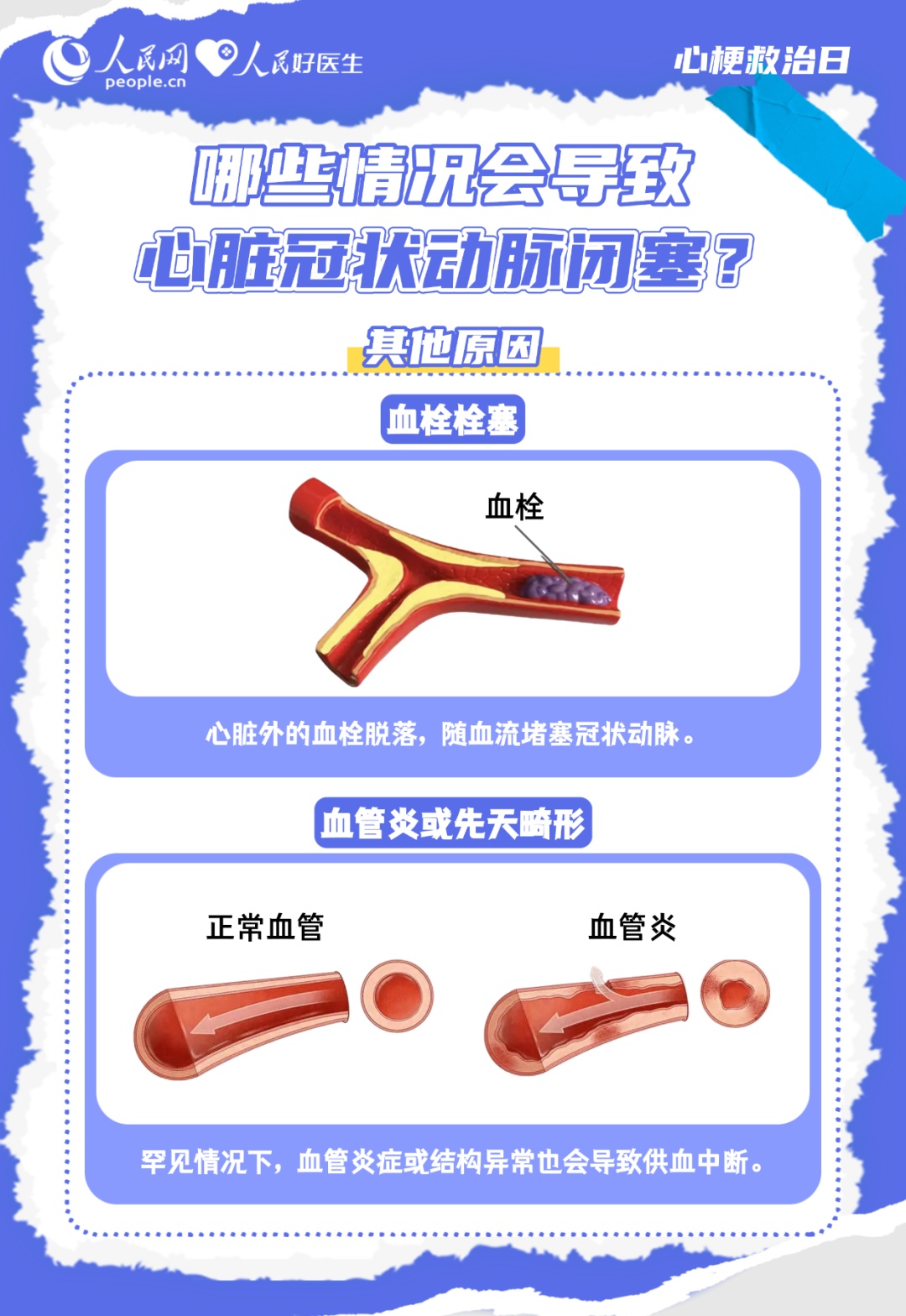 看懂心梗信号 掌握健康主动权