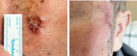 确诊癌症！女子一颗痣长了几十年，医生紧急提醒