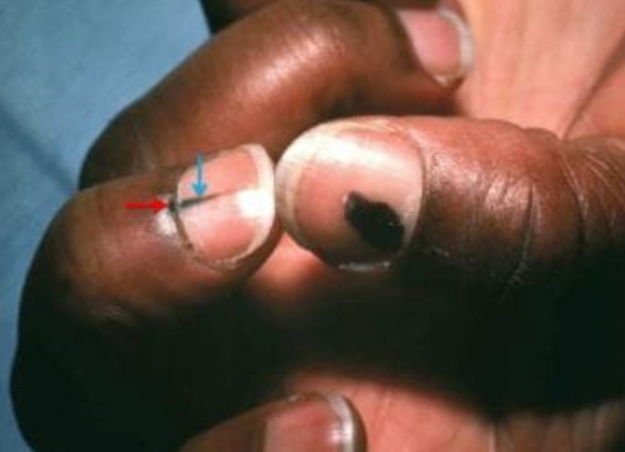 指甲上月牙少=不健康？白斑是疾病信号？别慌！这4种情况才真的要警惕