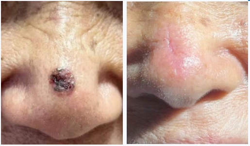 确诊癌症！女子一颗痣长了几十年，医生紧急提醒