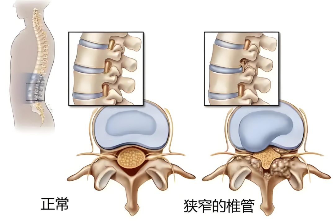 别把腰疼当小事!一种是“越走越疼”,一种是“休息也疼”,辨清病因是关键 别把腰疼当小事!一种是“越走越疼”,一种是“休息也疼”,辨清病因是关键