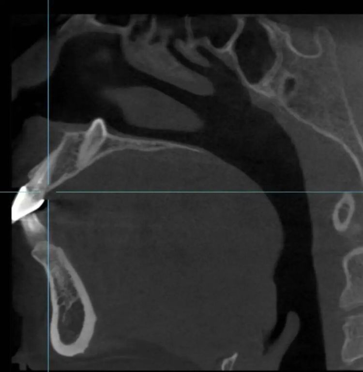 台州一高中生有颗牙长进鼻子了！医生：并非个例，相当常见