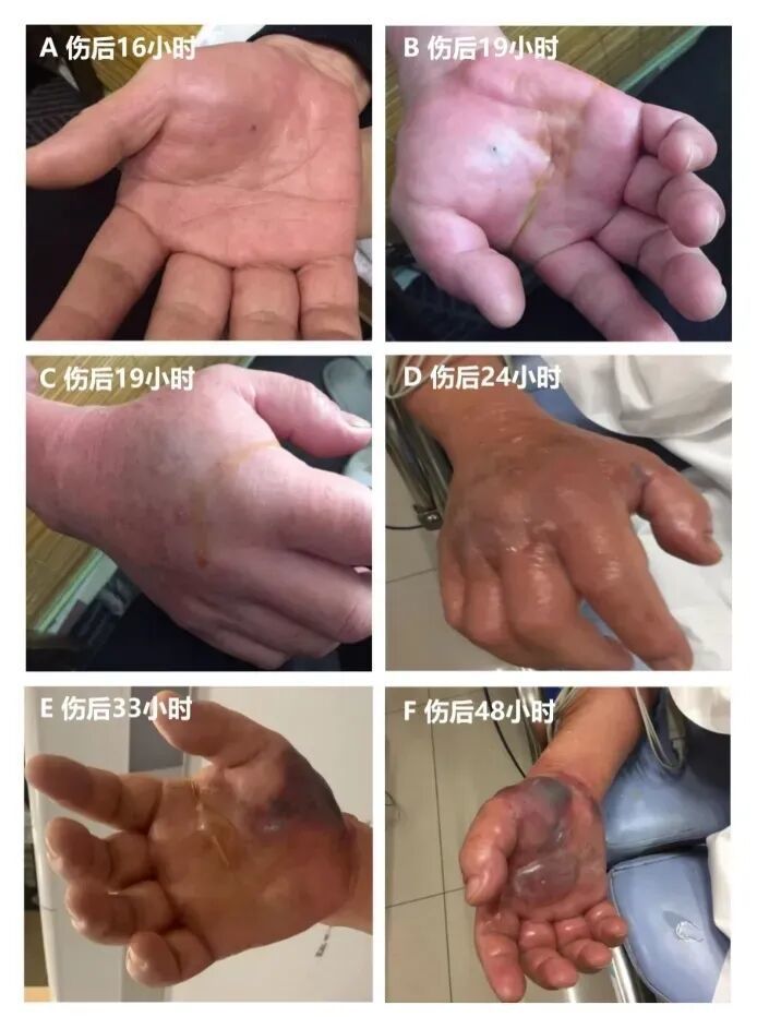 被扎了一下手，几天后不幸离世！注意：处理海鲜时，这些细节能保命