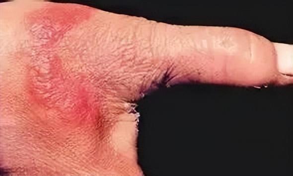 一男子处理海鲜时不小心被扎伤，几天后突然去世！处理海鲜的致命雷区，很多人不知道