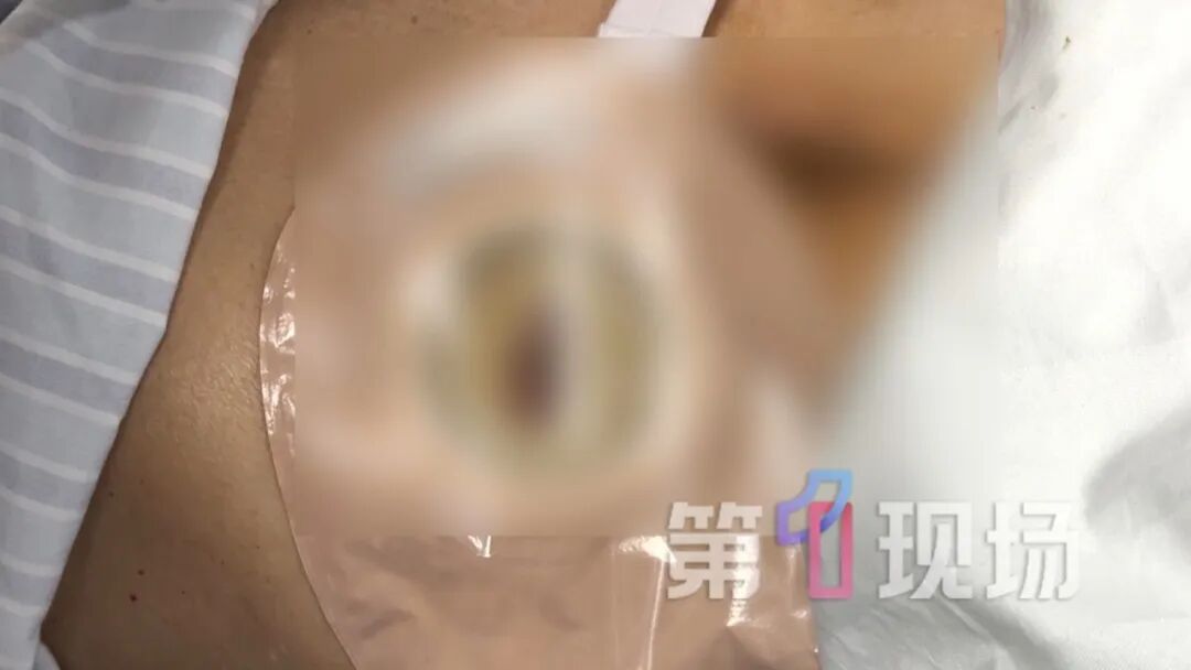 “粪便从口里喷涌而出”！医生：再晚一天就危险了
