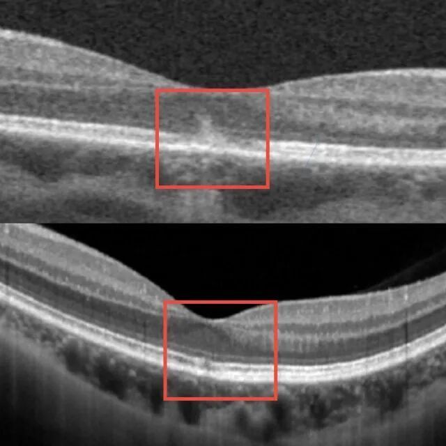 女子美容后视力骤降！请注意，这个操作1秒都不行