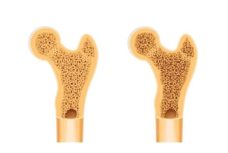 一个炒菜习惯，可能让家人骨质疏松