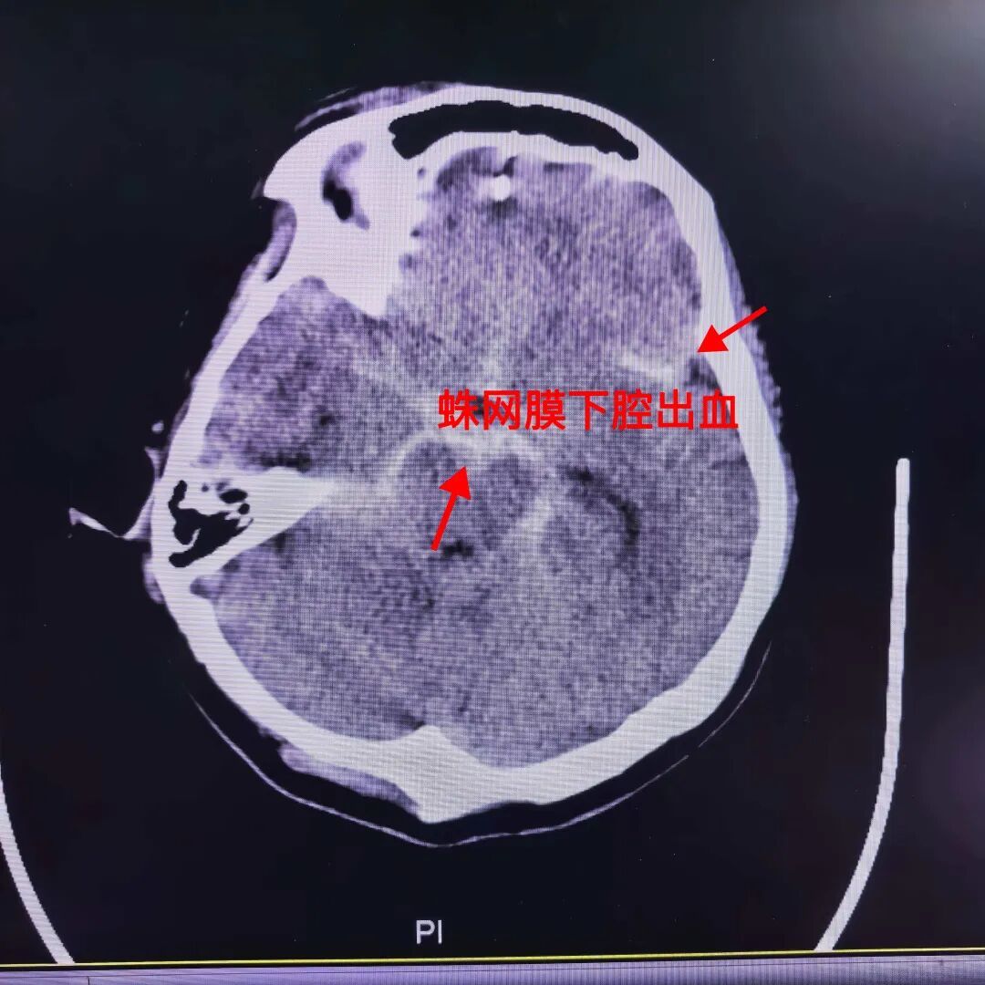 差点出大事！女子打麻将连续“自摸”，激动过头突然倒下