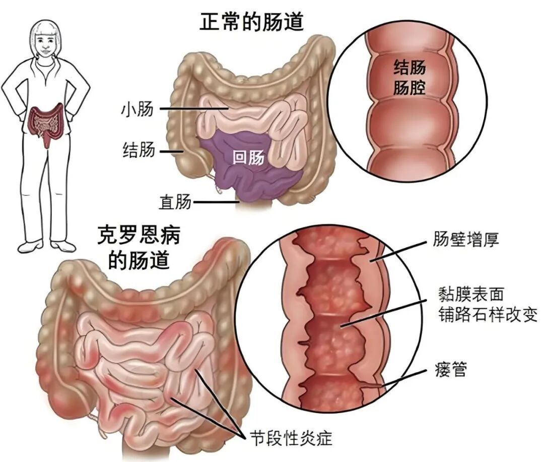男子腹泻一天拉7次，持续五六年！这病深圳较常见…