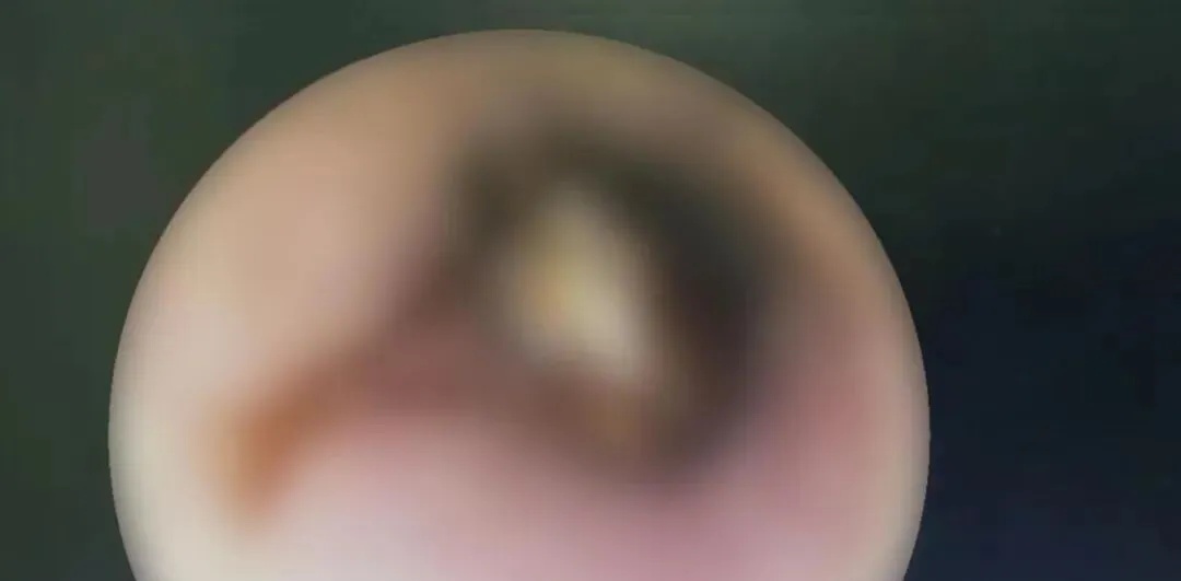 害怕的事发生了！男子半夜耳朵剧痛，医生取出一只蟑螂：“以为有好吃的”
