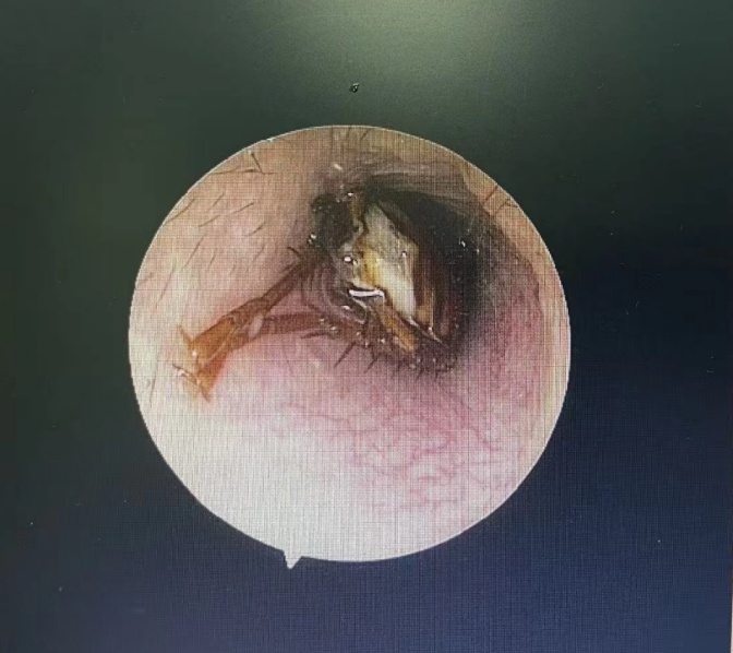 头皮发麻！广州一男子半夜耳痛，竟被挖出蟑螂