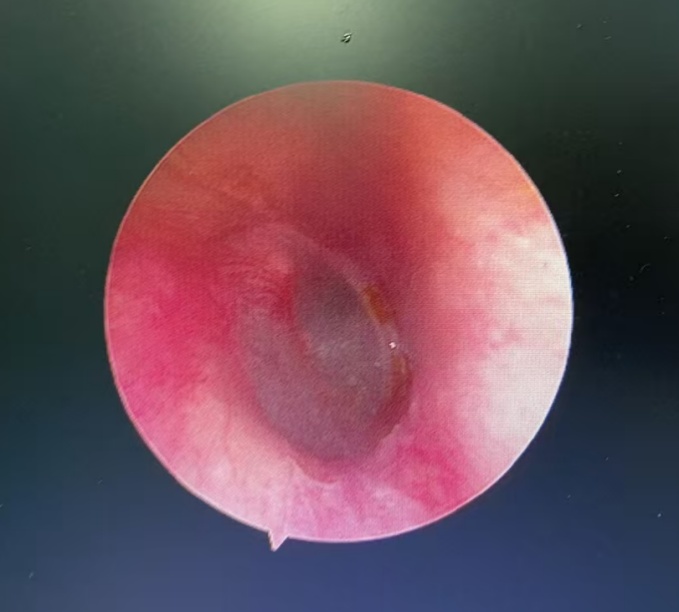 头皮发麻！一男子半夜耳痛，耳道内挖出整只蟑螂……