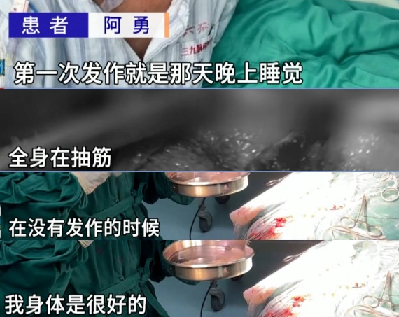 寄生虫在男子脑内“安家”21年!医生提醒:不吃生食、不喝生水 寄生虫在男子脑内“安家”21年!医生提醒:不吃生食、不喝生水