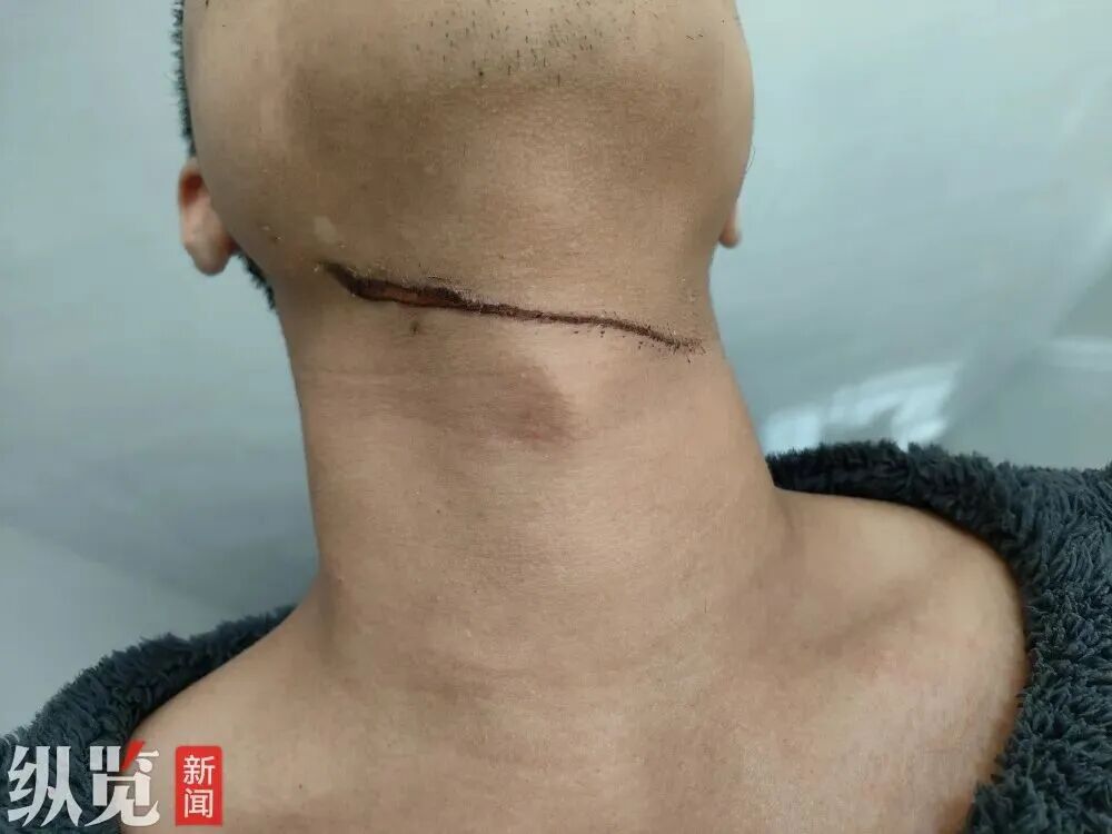 男子骑车遭晾衣绳“割喉”！物业：事发监控盲区，尚未找到拴绳人