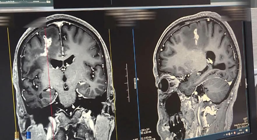 寄生虫在男子脑内“安家”21年!医生提醒:不吃生食、不喝生水 寄生虫在男子脑内“安家”21年!医生提醒:不吃生食、不喝生水
