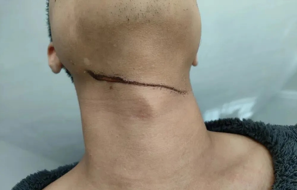 “一摸满手是血”！男子回家途中遭晾衣绳“割喉”，架绳人至今没找到，物业回应